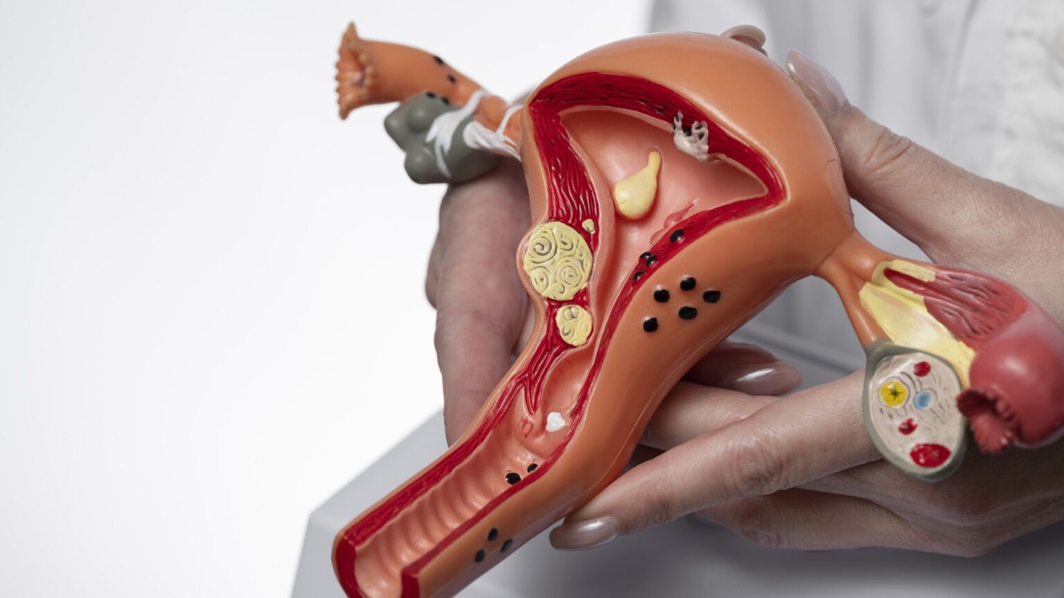Planos de saúde passam a cobrir DIU hormonal para endometriose a partir de 1º de outubro